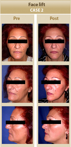 Cirugia Facial